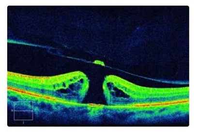 Macular hole