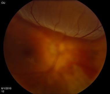 Retinal Detachment