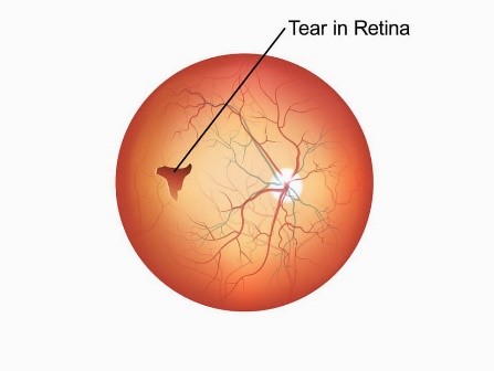 Retinal Tear