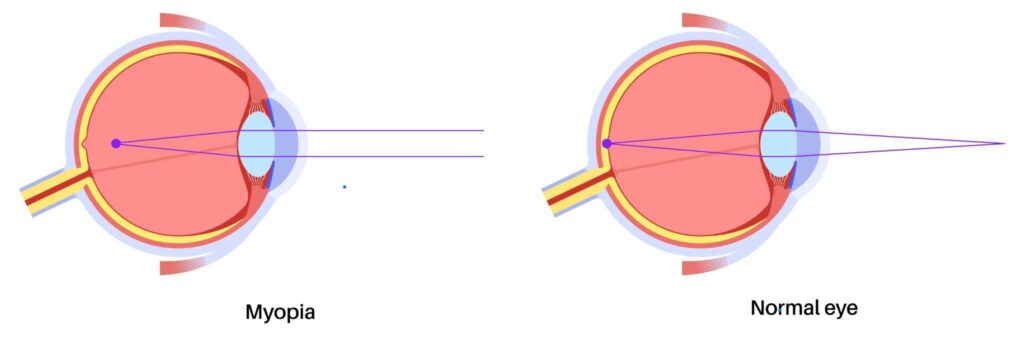 Types of myopia