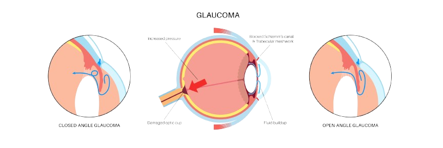 Glaucoma