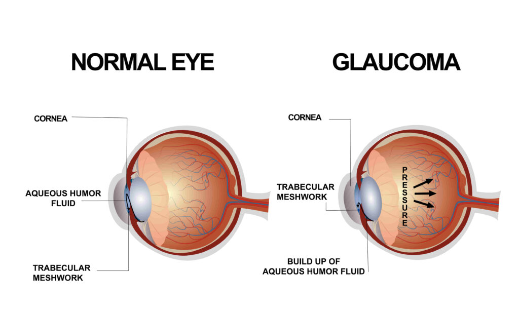 Normal Eye & Glacoma Eye