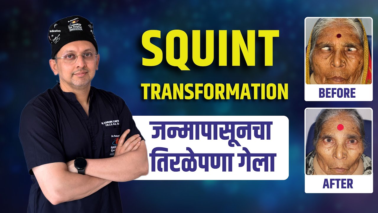 जन्मजात तिरळेपणा दूर झाला | Squint Transformation | Squint Since Birth Corrected Successfully