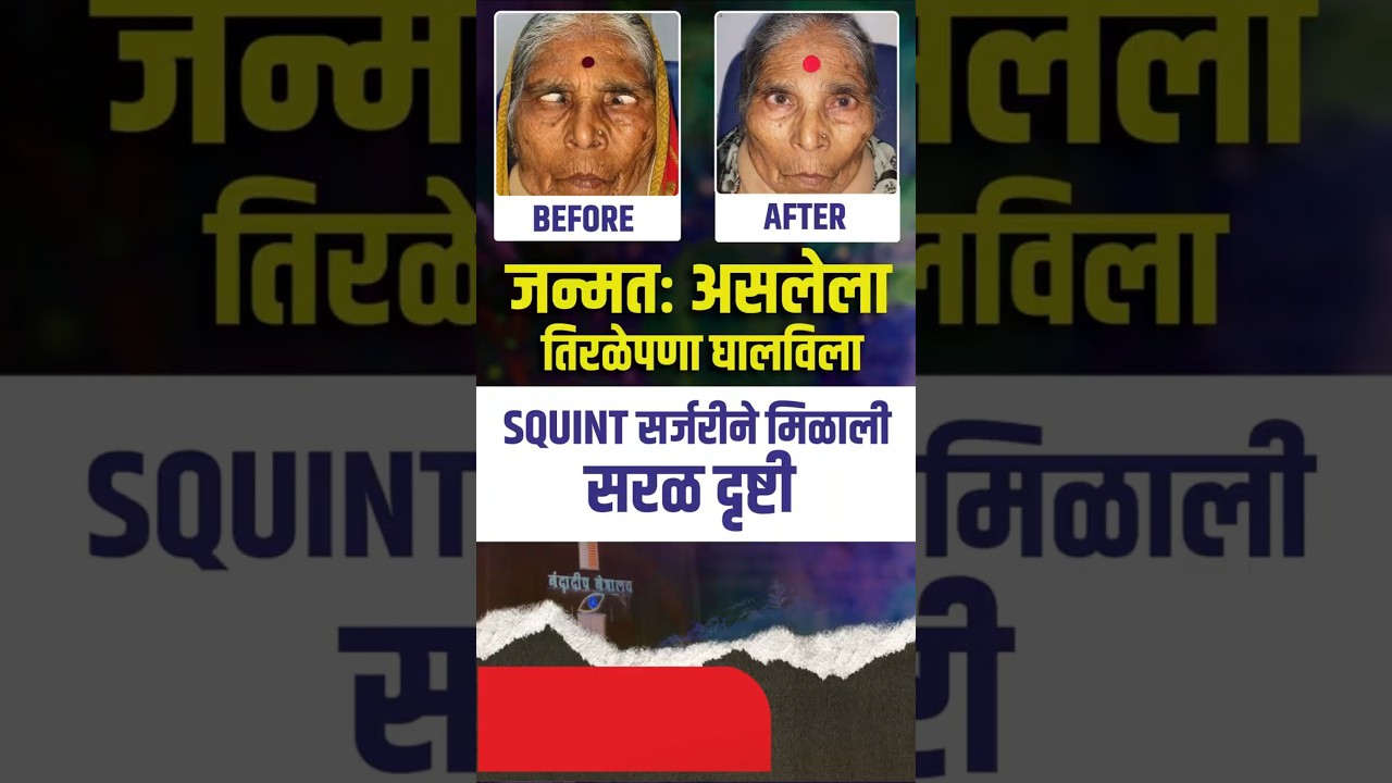 जन्मतः असलेला तिरळेपणा घालविला | SQUINT Surgery ने मिळाली सरळ आणि स्पष्ट दृष्टी | Squint Treatment