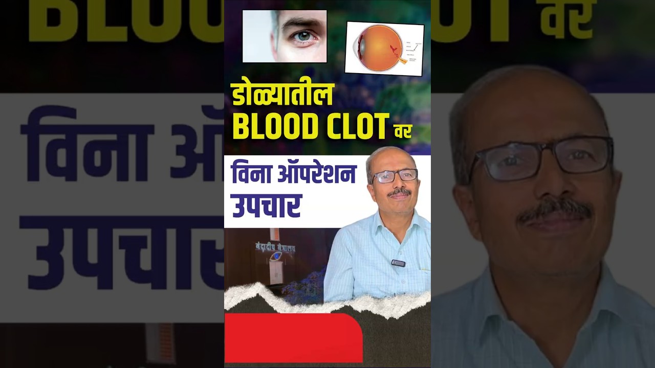 डोळ्यातील ब्लड क्लोटवर विना ऑपरेशन उपचार