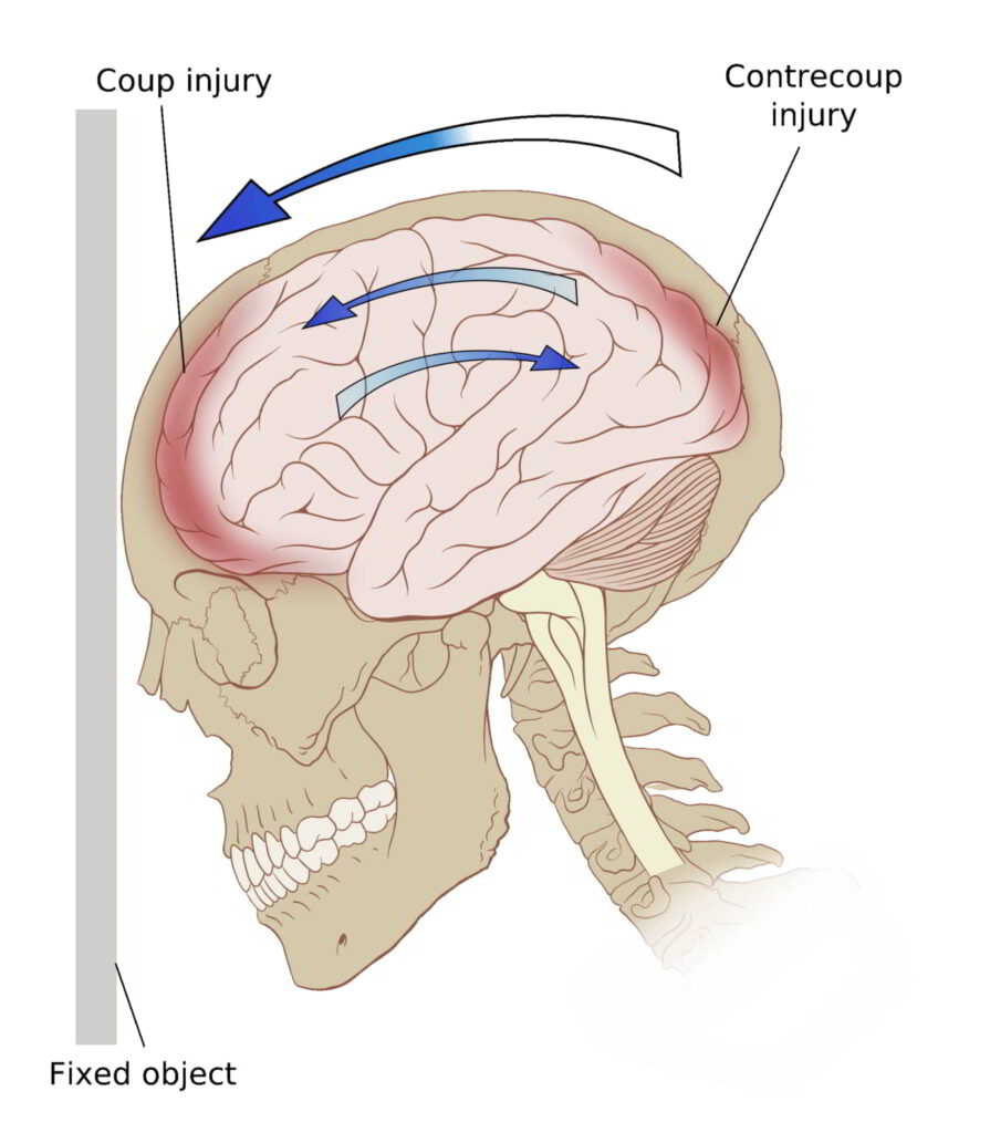 Concussion and Vision