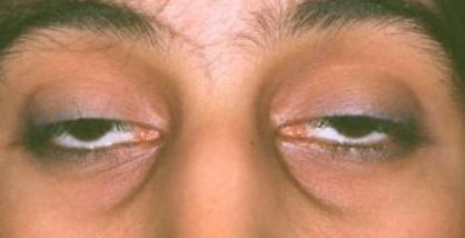 External Ophthalmoplegia Nandadeep