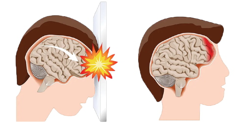 Traumatic Brain Injury Nandadeep