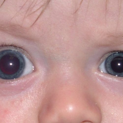 Juvenile Glaucoma: Early Detection & Treatment from Experts