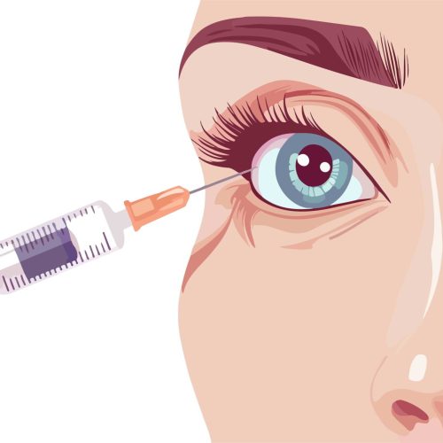 Eye Injections Explained: Benefits, Risks & Procedures